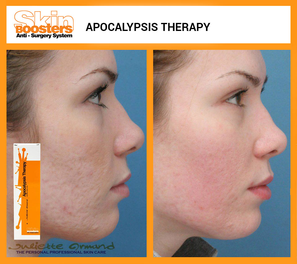 Skin Boosters - Apocalypsis The